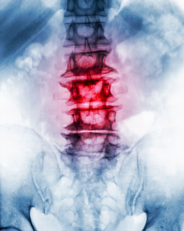 Spinal joint dysfunction may be helped by chiropractic